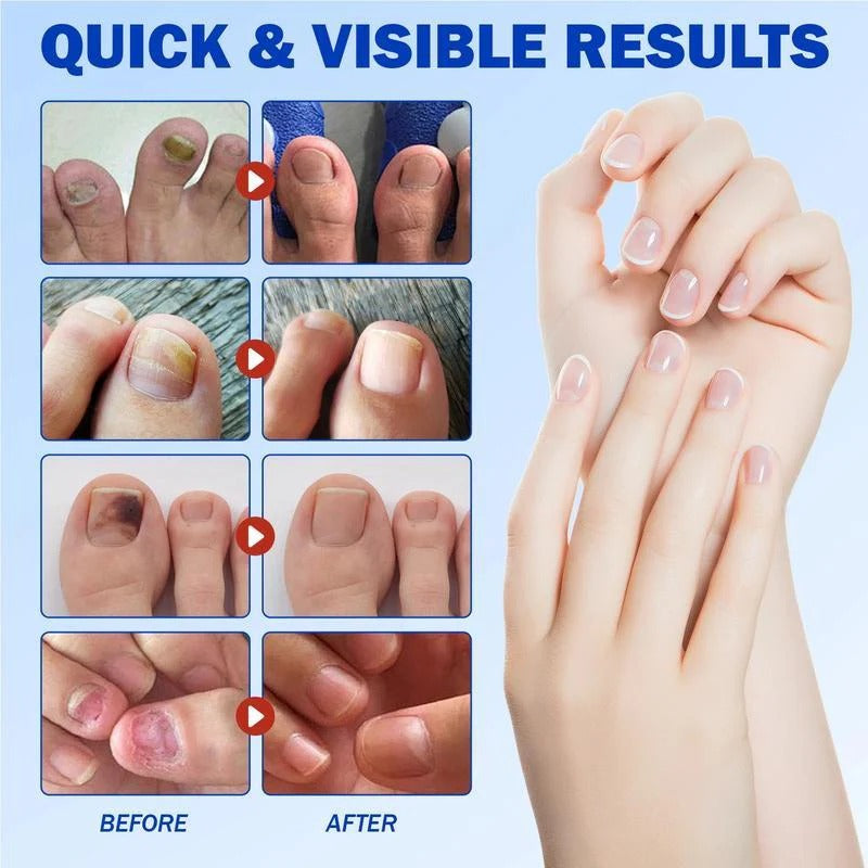 FUNGEX™ – Nagelpflaster gegen Nagelpilz