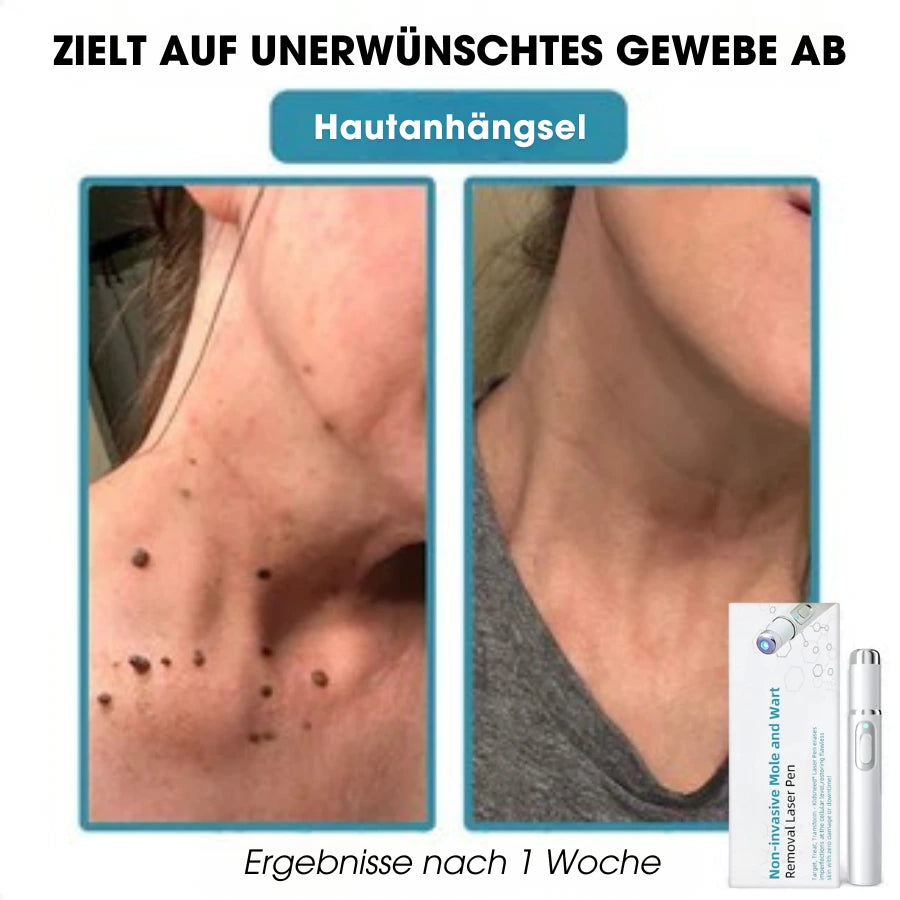 DermaLight Pro™ – Nicht-invasiver Laserstift für Muttermale, Warzen und Hautanhängsel