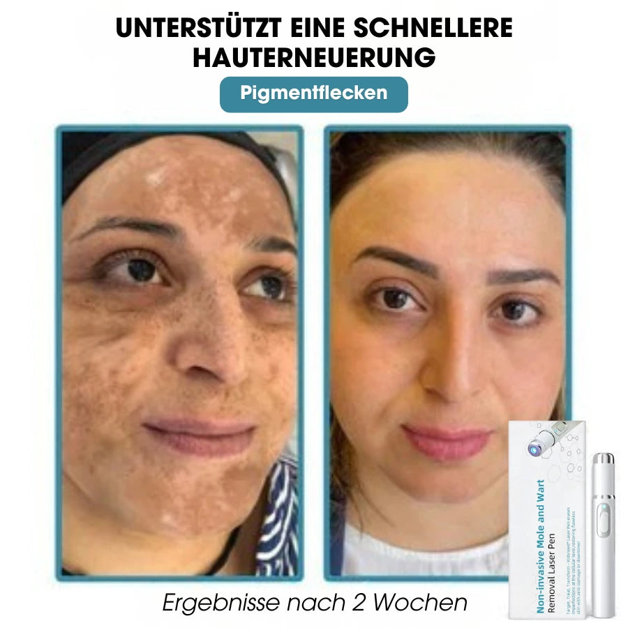 DermaLight Pro™ – Nicht-invasiver Laserstift für Muttermale, Warzen und Hautanhängsel