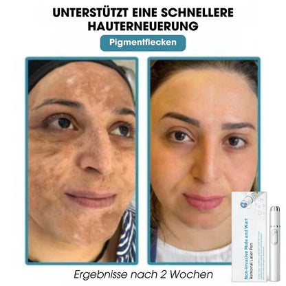 DermaLight Pro™ – Nicht-invasiver Laserstift für Muttermale, Warzen und Hautanhängsel