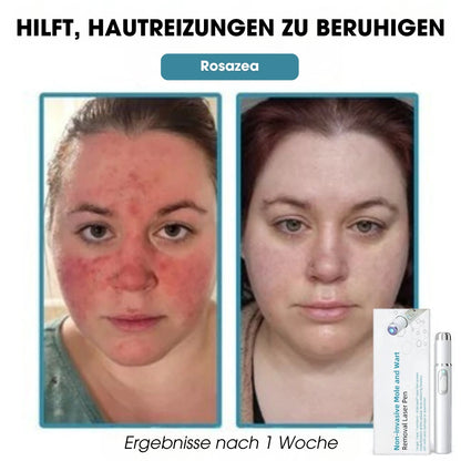 DermaLight Pro™ – Nicht-invasiver Laserstift für Muttermale, Warzen und Hautanhängsel