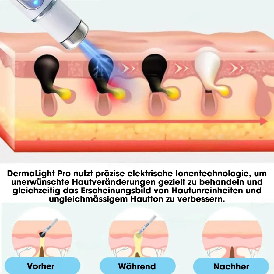 DermaLight Pro™ – Nicht-invasiver Laserstift für Muttermale, Warzen und Hautanhängsel
