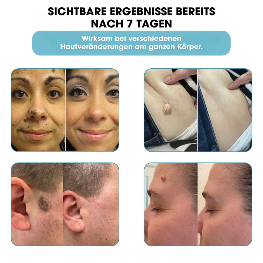 DermaLight Pro™ – Nicht-invasiver Laserstift für Muttermale, Warzen und Hautanhängsel